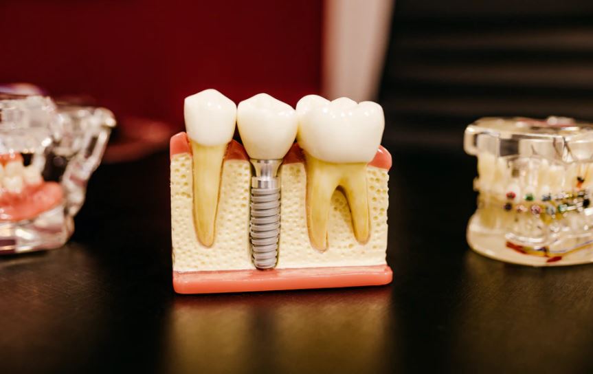 Dental-Implant