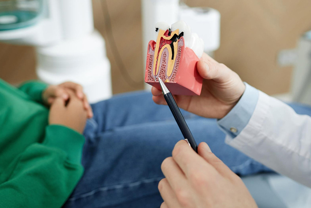Root-Canal