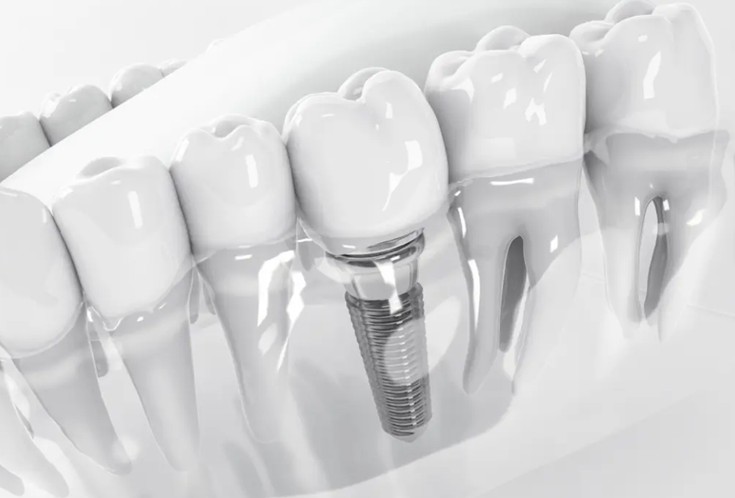 Dental-Implants
