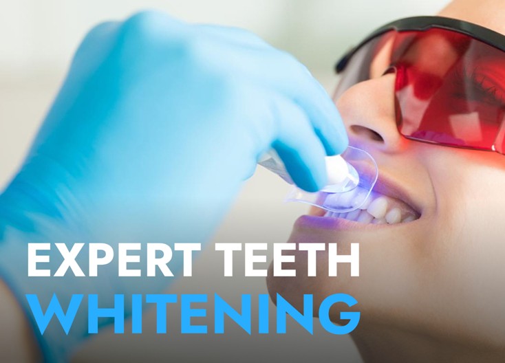 Teeth-Whitening