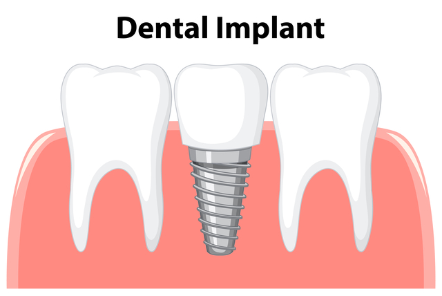 Dental-Implants